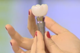  Recomandări pentru pacient după implantare dentară