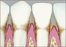 View of gingivitis