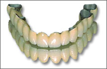 Ceramic-metal denture in Chisinau Moldova