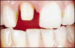 Tooth before ceramic-metal crown
