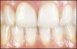 After prosthetics